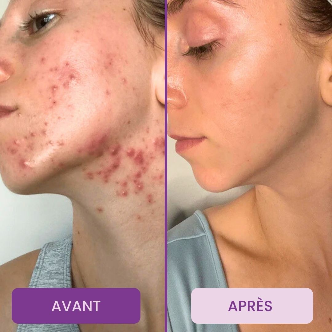 Halo V2™ – 6 minutes pour révéler la peau que vous méritez